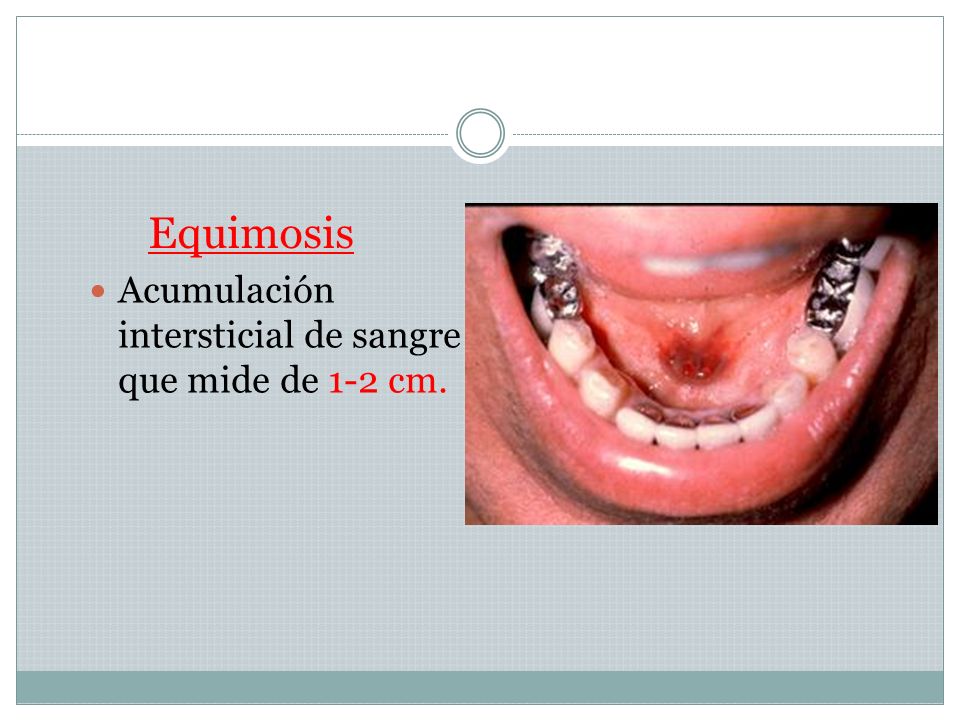 Las pecas en la mano izquierda